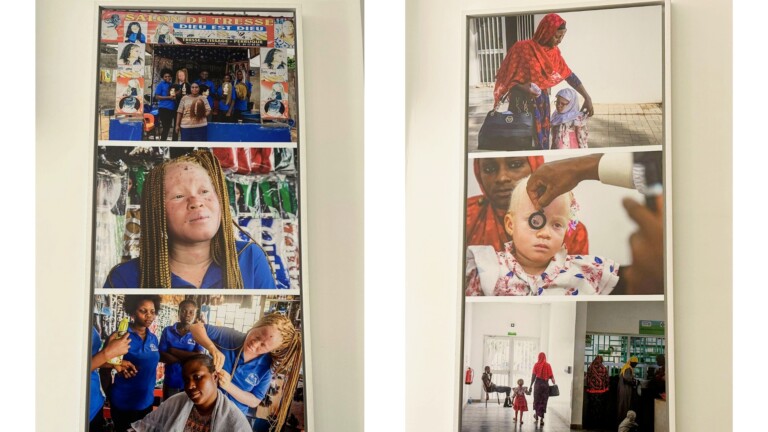 Exposition albinisme